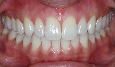 Gum Depigmentation